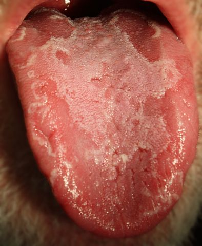 Illustration for article titled Do You Have A Geographic Tongue?